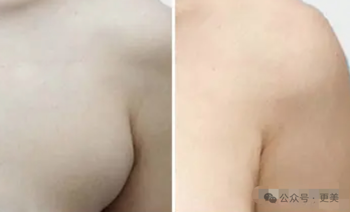 △如果是真性副乳，需要通过手术摘除